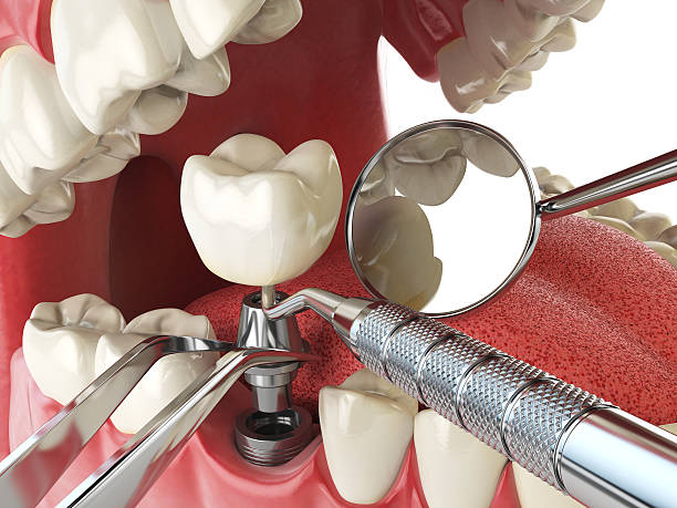 Best Emergency Wisdom Teeth Removal in Scotchtown, NY